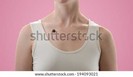 Melanoma, skin cancer, mole in the chest of a beautiful woman. High definition image.