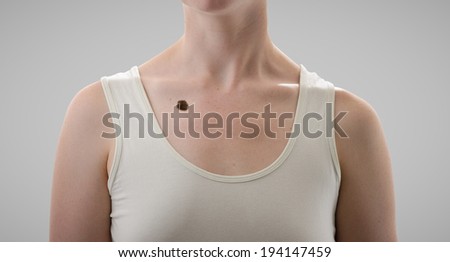Melanoma (skin cancer, mole) in the chest of a beautiful woman. High definition image.