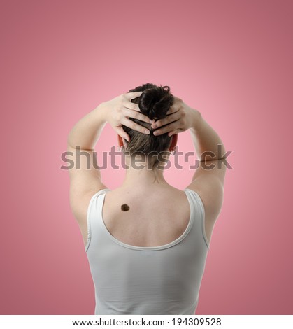 Melanoma (mole, skin cancer) in the back of a beautiful woman, isolated on pink background. High definition image.