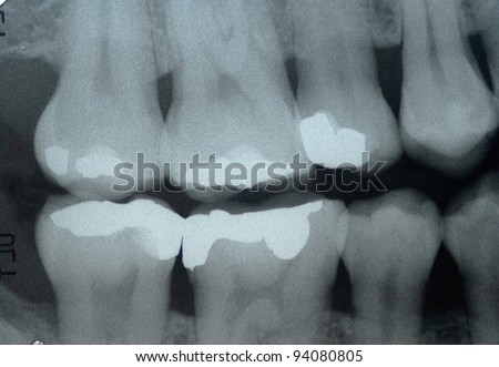 Dental x-ray  ( Bite wing technic ) for check dental caries