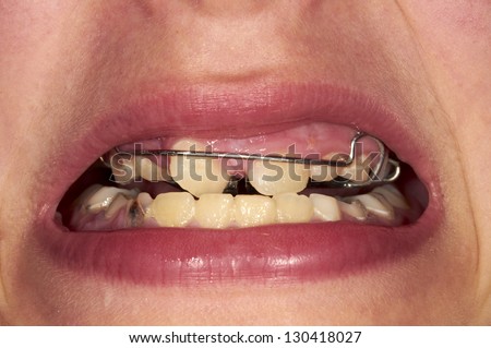 Close-up mouth of tooth with braces