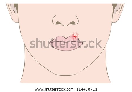 Herpes Virus Mouth