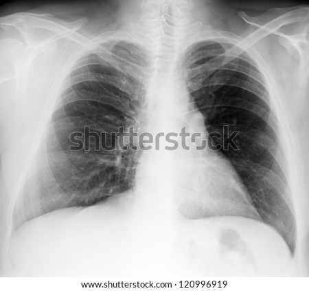 Male chest x-ray on black background