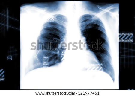 Male chest x-ray on black background