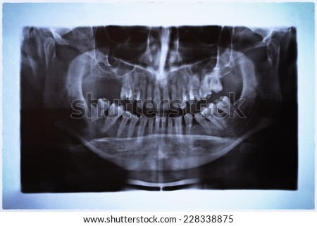 Photo of teeth x-ray