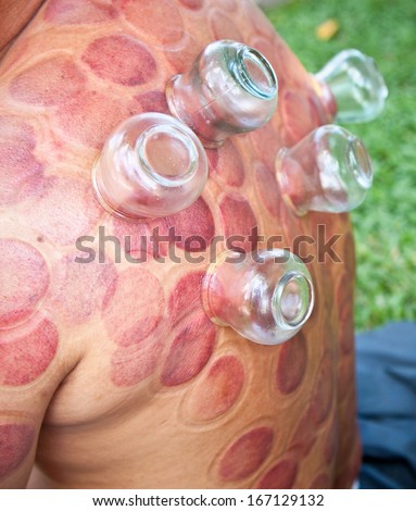Cupping therapy is an ancient form of Chinese alternative medicine in Ho Chi Minh, Vietnam.