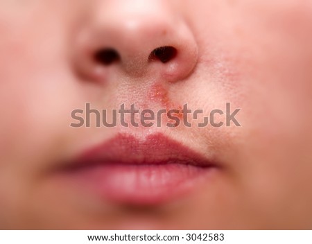 herpes pictures. with virus herpes on her