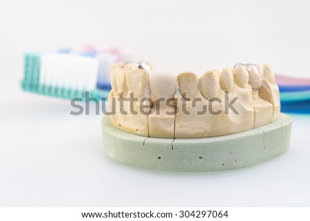 Dental cast during processing denture