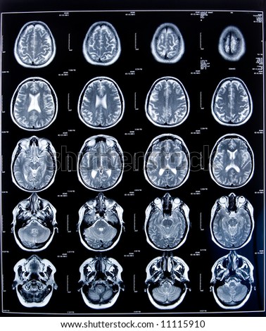 health medical image of an mri of the head showing the brain