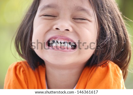 Little child with broken and rotten teeth