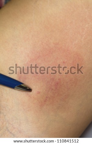 Allergic reaction after insect  bite-acute state- rash skin texture of patient.  Pen shows the spot of bite.