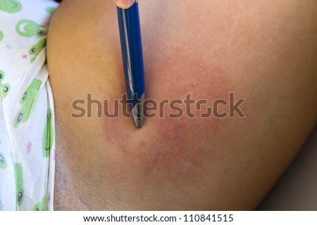 Allergic reaction after insect  bite-acute state- rash skin texture of patient.  Pen shows the spot of bite.