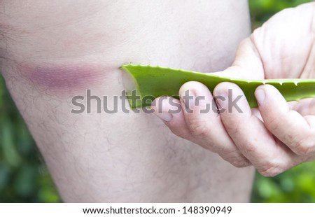 Using  of ALOA VERA leaf after insect bite, Allergic reaction after insect  bite-acute state- rash skin texture of patient