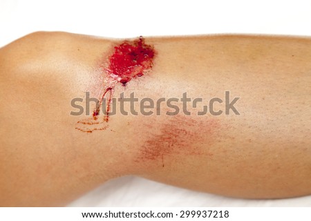 Sport injury - painful knee wound accident. Close up on an bleeding scraped human knee after skating accident. Against white background, closeup, space for text