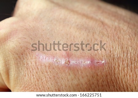wound healing scar on man\'s hand