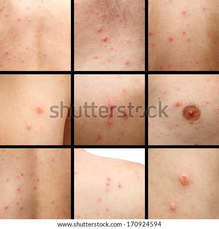 details of chicken pox blotches on human skin