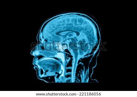 magnetic resonance image (MRI) side view of the head isolated on black background with clipping path