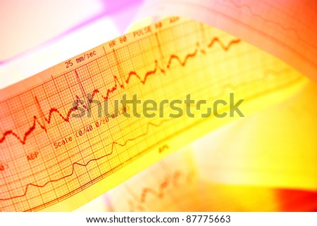 ECG print (Pulse trace)