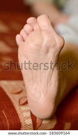 Fungus Infection on Man's Foot. Callus and hyperkeratosis on feet
