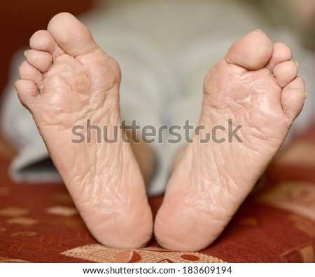 Fungus Infection on Man\'s Foot. Callus and hyperkeratosis on feet