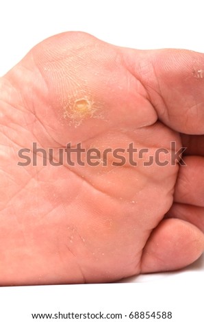 Corn On Foot Stock Photo 68854588 : Shutterstock