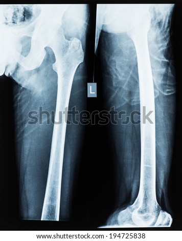radiograph of the pelvis for a medical diagnosis