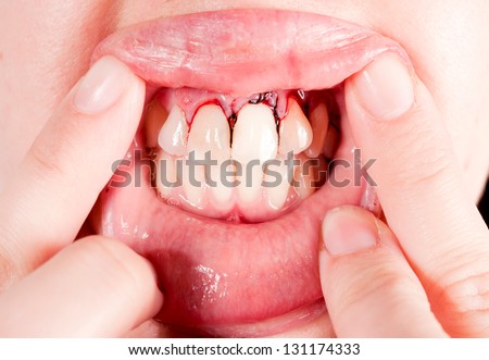 Close up to female teeth after the surgery. Selective focus on the teeth