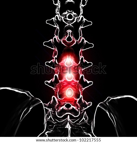 3d rendered anatomy illustration - painful back , a view of back pain from back side and the concentrated area are highlighter