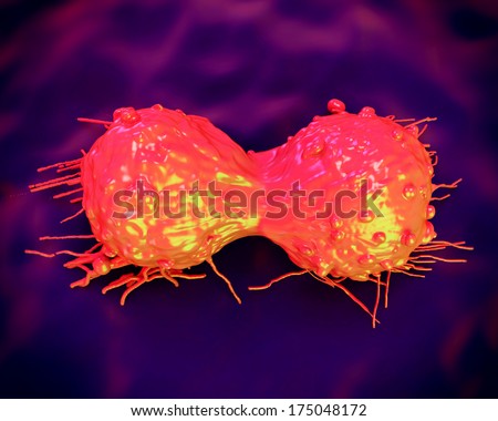 Cervical cancer cell, SEM of Cervical Carcinoma