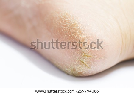 Female foot heel pain