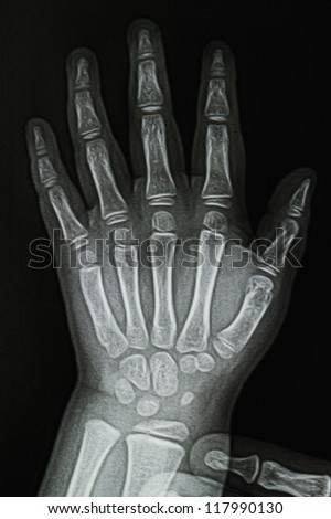 Children  hand x-ray image