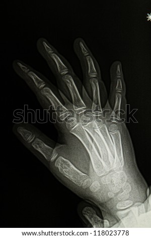 Children  hand x-ray image