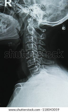 cervical spine,neck  x-ray image