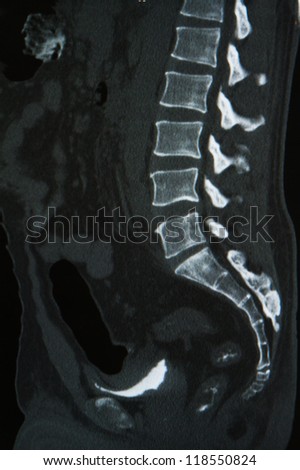 lumbar spinal column and sacrum bone x-ray image