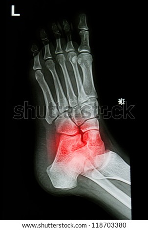 x-rays image of  the painful or injury ankle and foot