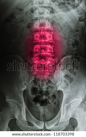 injury or painful of back  x-rays image, spinal cord injury