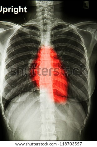 x-rays image of  the painful chest or heart attack