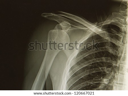 x-rays image of  the painful or injury shoulder joint ,shoulder dislocation