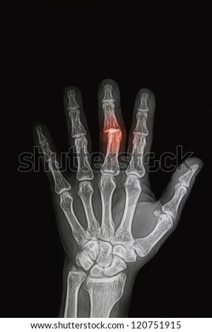 wrist and hand  x-rays image show fracture and dislocation bone