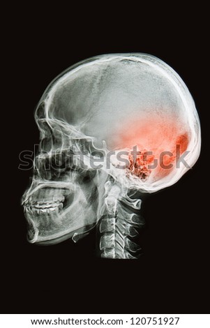 skull x-rays image  sag ital plane show head injury