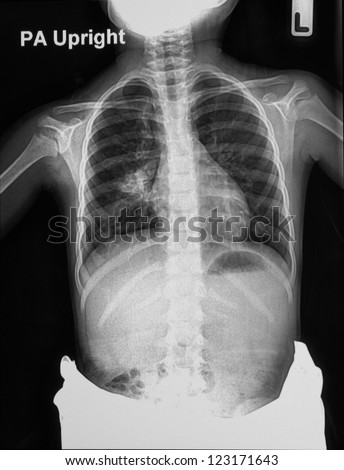 Children chest X-rays