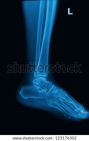 ankle and foot x-rays image lateral