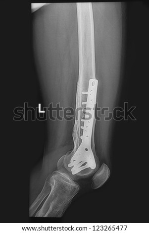 broken human thigh x-rays image ,Left leg fracture