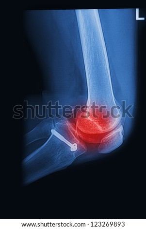 X Rays image  broken knee joint with implant,Image x-rays painful of knee joint
