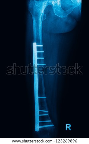 Fracture femur, femur x-rays image showing plate and screw fixation