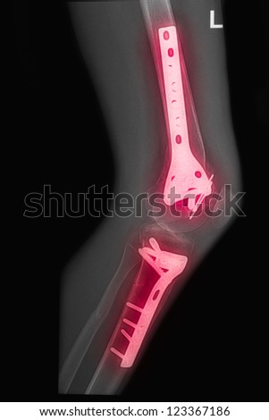 X Rays image  broken thigh and leg with implant,Image x-rays painful of left leg