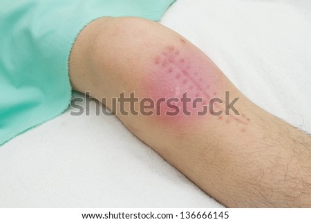 the knee joint injury , Patient demonstrating surgery wound post operation