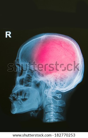 x-ray image of human skull show head injury
