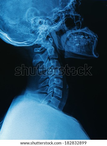 X-ray human skull and spine ( cervical spine )