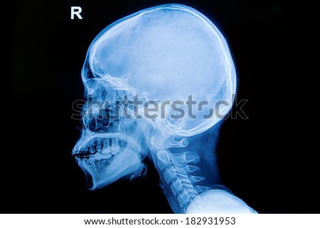 X-ray human piece of skull and cervical  spine